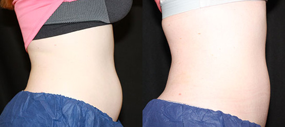Before and After Front