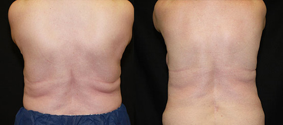 Before and After Side