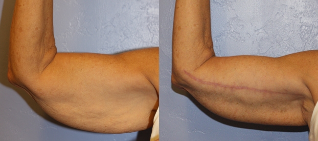 Bilateral Brachioplasty (Arm Reduction) Case 4