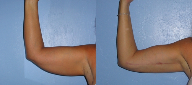 Bilateral Brachioplasty (Upper Arm Reduction) Case 3
