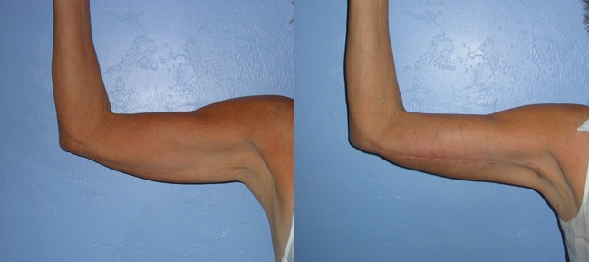 Bilateral Brachioplasty (Arm Reduction) Case 2