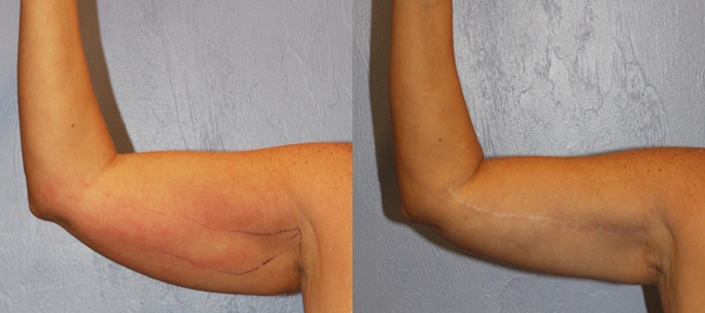 Bilateral Brachioplasty (Arm Reduction) Case 1