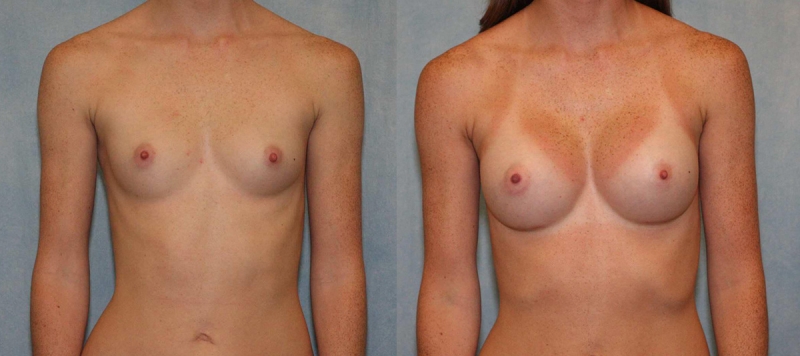 Breast Augmentation Case 26