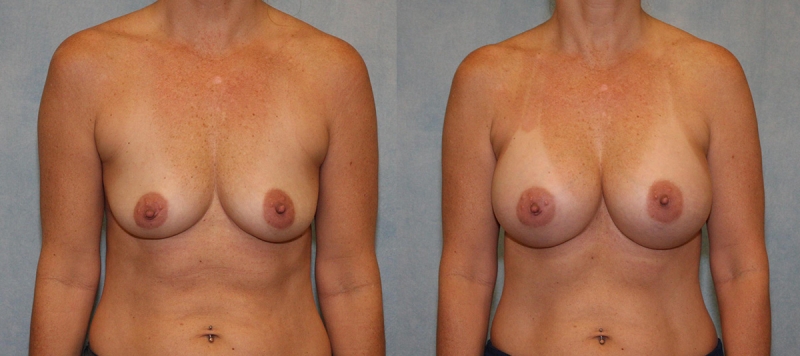 Breast Augmentation Case 25
