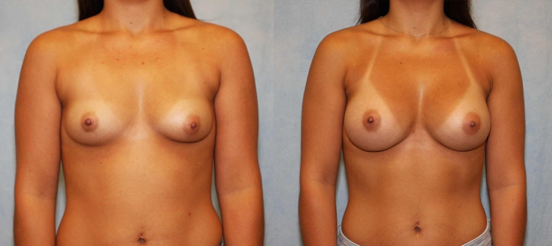Breast Augmentation Case 14