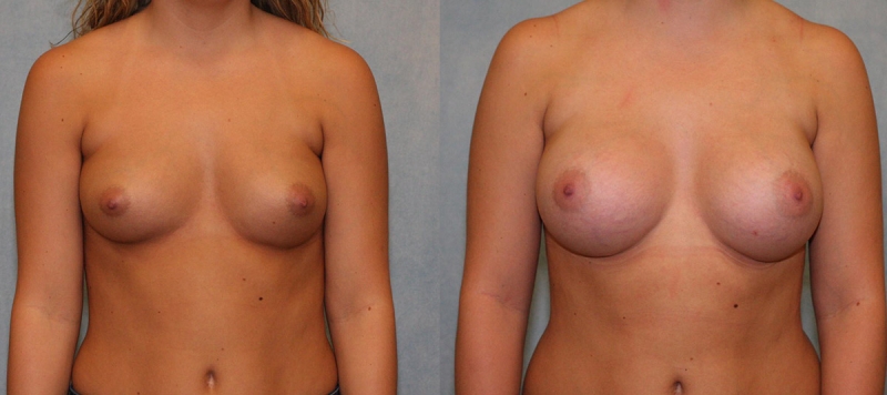 Breast Augmentation Case 7