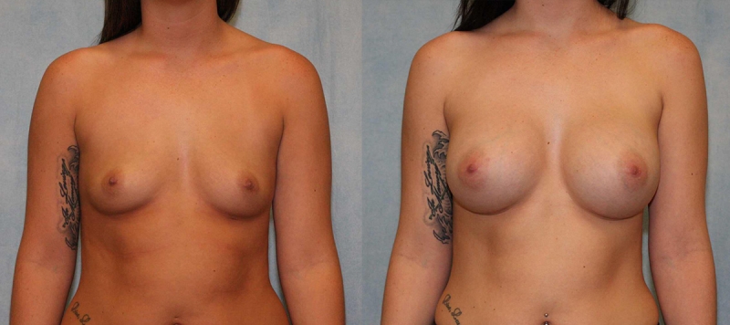 Breast Augmentation Case 23