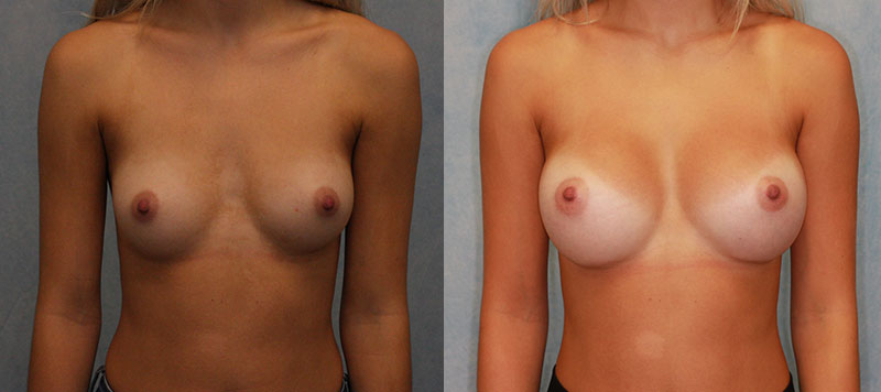 Breast Augmentation Case 2