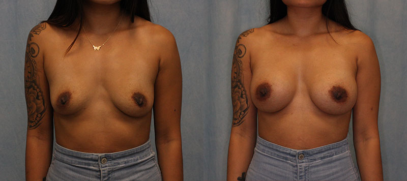 Breast Augmentation Case 1