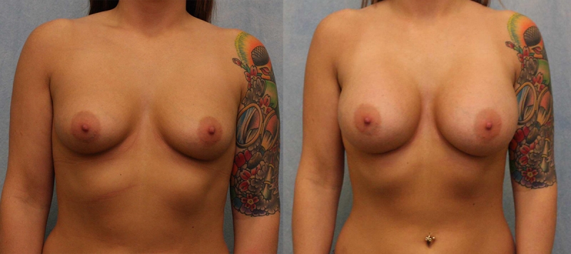 Breast Augmentation Case 20