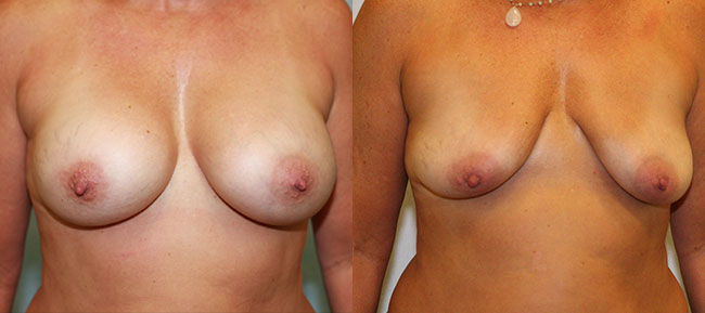 Breast Implant Removal Case 3
