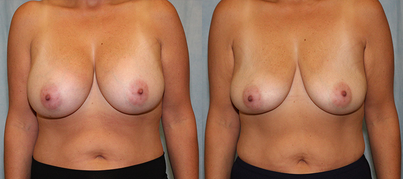 Breast Implant Removal Case 2