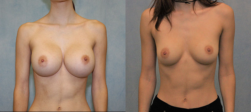 Breast Implant Removal Case 1