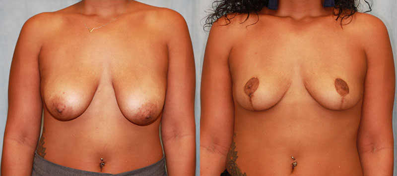 Breast Lift Case 1