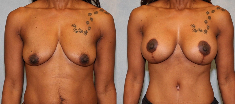 Breast Lift with Implants Case 6