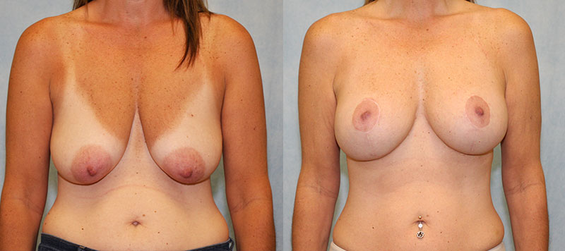 Breast Lift with Implants Case 5