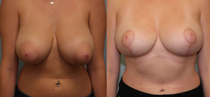 Breast Reduction Case 1