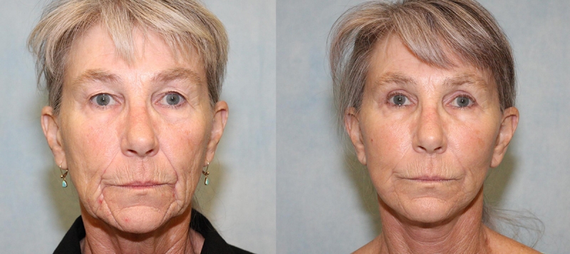 Face and Upper Eyelids Case 3