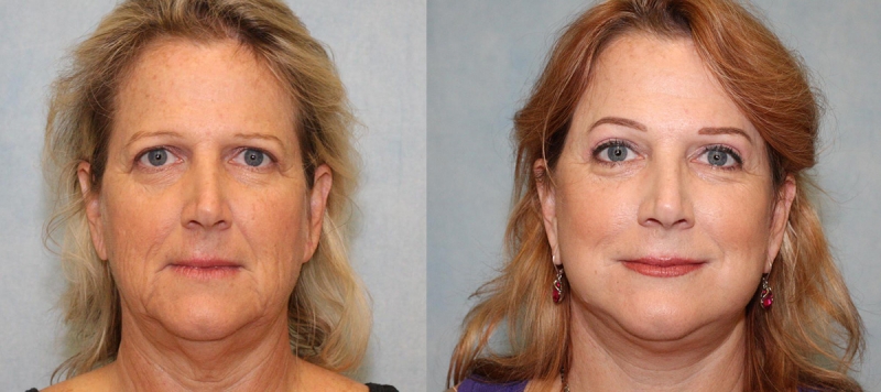Face Lift, Upper Eyelids and Brow Case 2