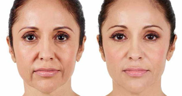 Juvederm Before and After 1