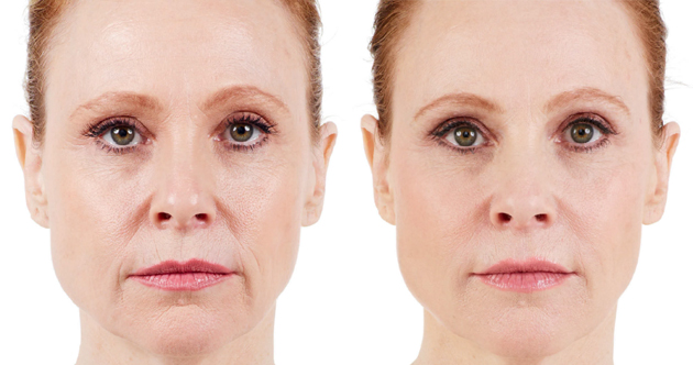 Juvederm Before and After 2