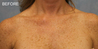 Before Vi Peel