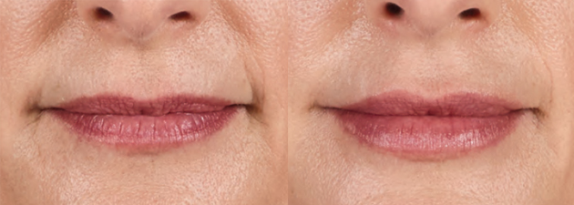Before and After Volbella XC - Front Close Up