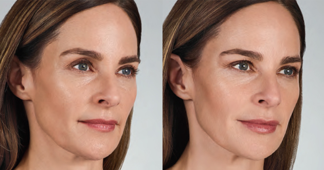Before and After Volbella XC - Side