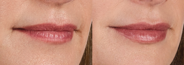 Before and After Volbella XC - Side Close Up