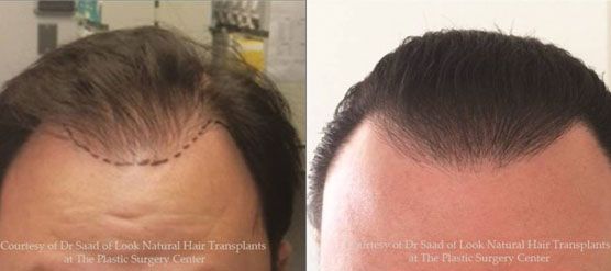 Hair Transplant Growth Chart