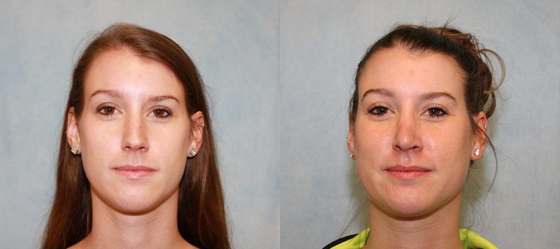 Rhinoplasty Patient 10 Image 3