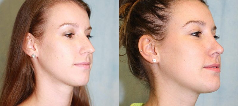 Rhinoplasty Patient 10 Image 2