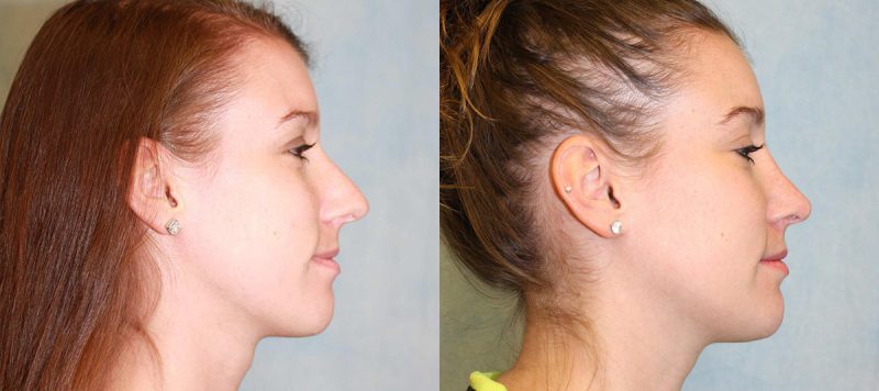 Rhinoplasty Patient 10 Image 1