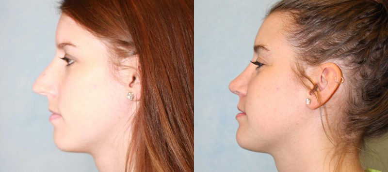 Rhinoplasty Patient 10 Image 0