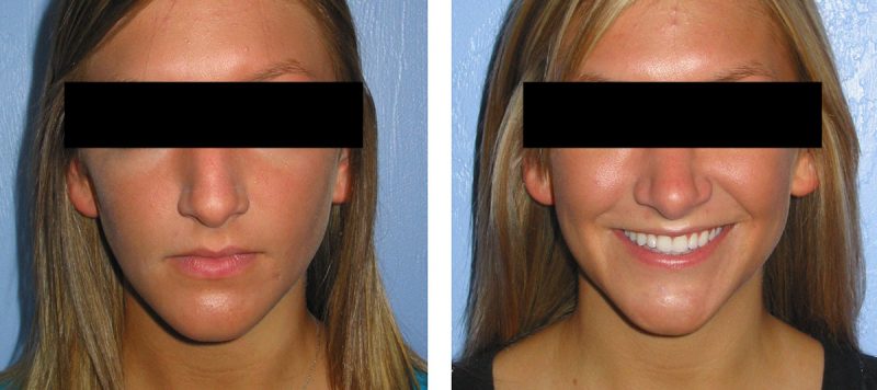 Rhinoplasty Patient 9 Image 3