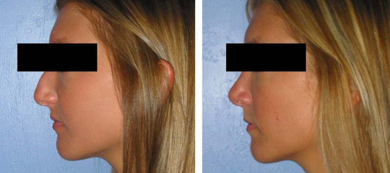 Rhinoplasty Patient 9 Image 2