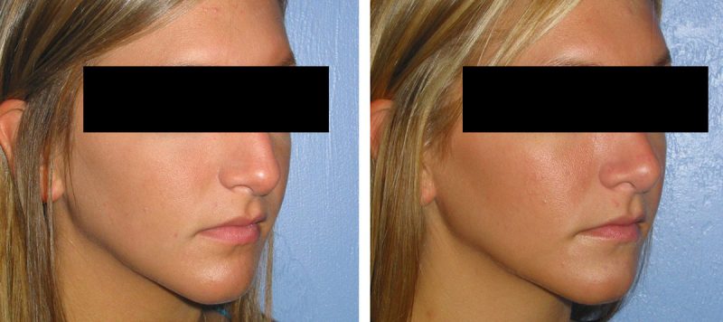 Rhinoplasty Patient 9 Image 1