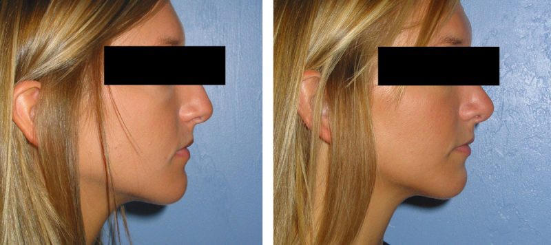 Rhinoplasty Patient 9 Image 0