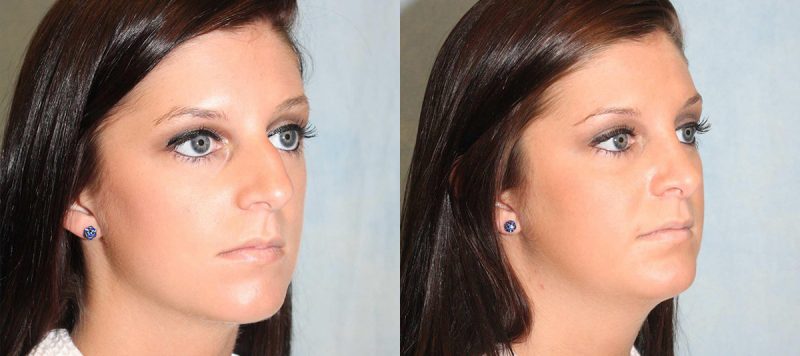 Rhinoplasty Patient 8 Image 2