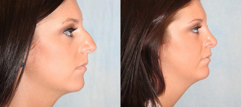 Rhinoplasty Patient 8 Image 1