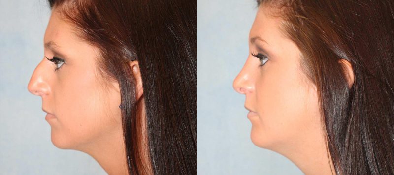 Rhinoplasty Patient 8 Image 0