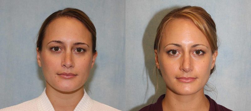 Rhinoplasty Patient 7 Image 3