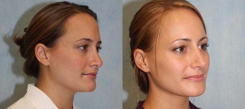 Rhinoplasty Patient 7 Image 2