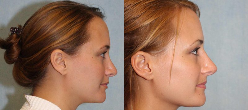 Rhinoplasty Patient 7 Image 0