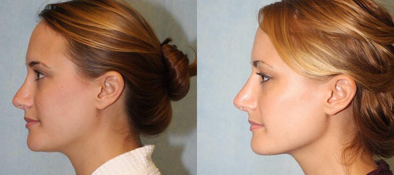 Rhinoplasty Patient 7 Image 1