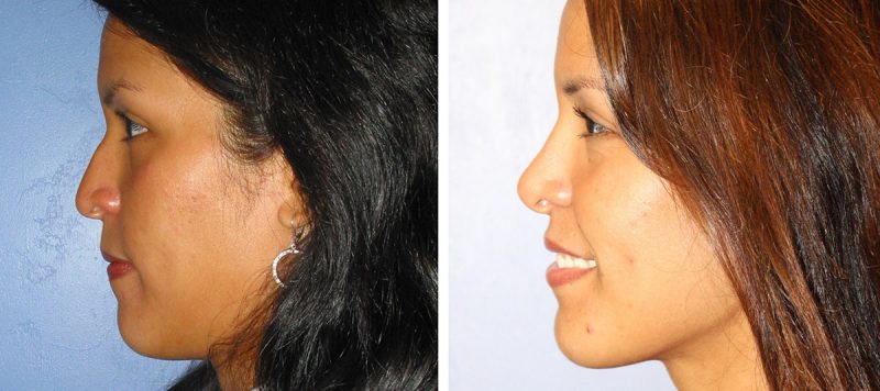 Rhinoplasty Patient 6 Image 2