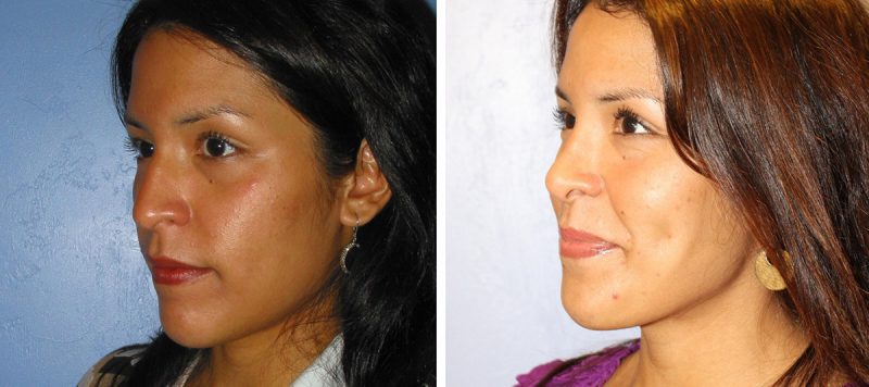 Rhinoplasty Patient 6 Image 1