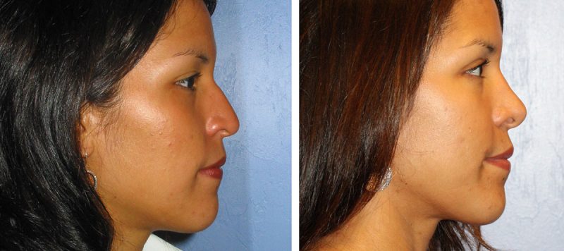 Rhinoplasty Patient 6 Image 0