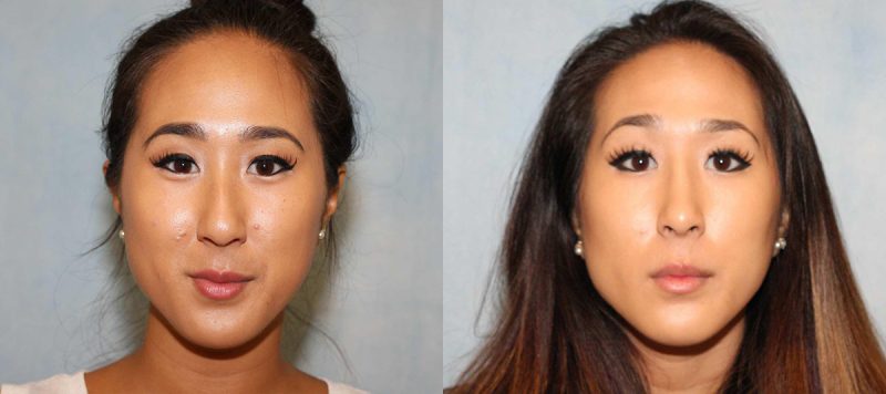 Rhinoplasty Patient 5 Image 1