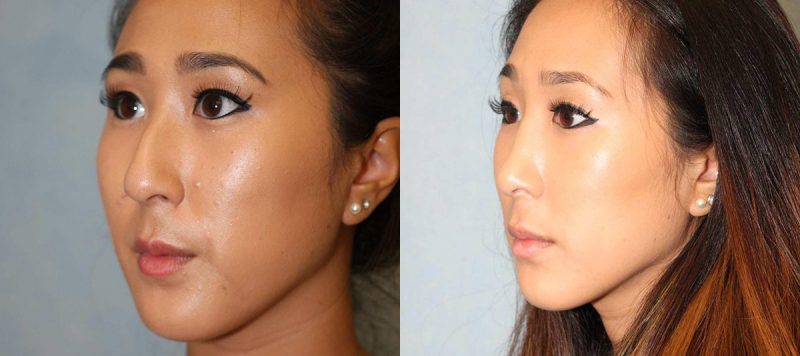 Rhinoplasty Patient 5 Image 3